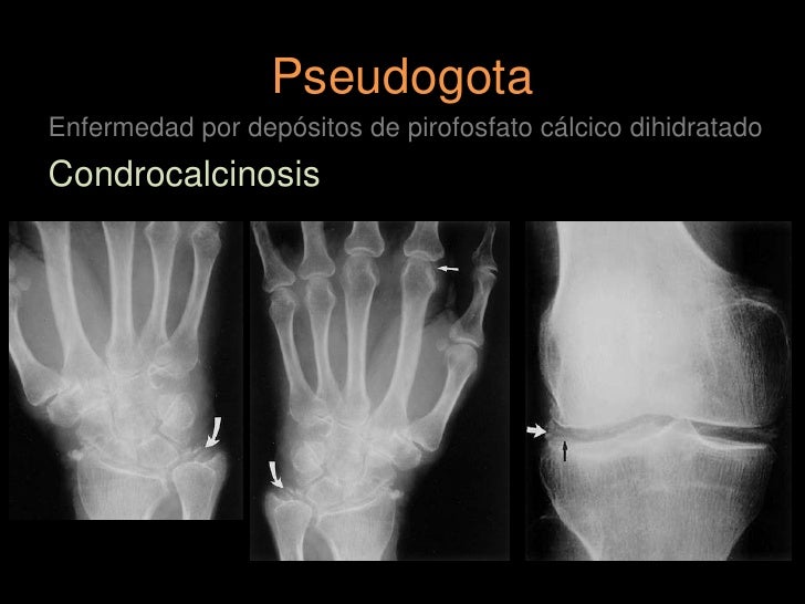 condrocalcinosis pseudogota